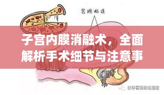 子宫内膜消融术，全面解析手术细节与注意事项