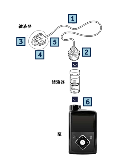 最新胰岛素泵技术革新助力糖尿病管理进步