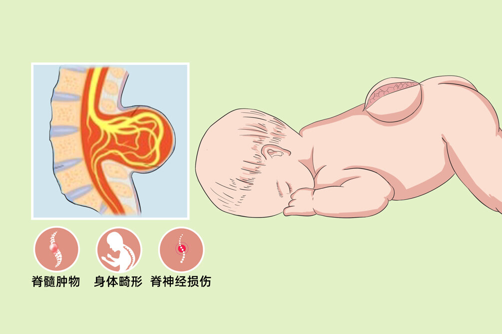 脊柱裂最新治疗方法揭秘，最新科技引领治疗革新