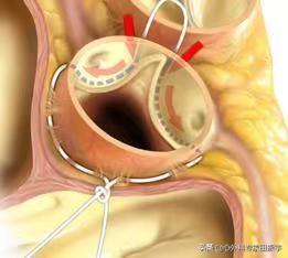 最新心脏瓣膜技术，重塑心脏健康的希望之光